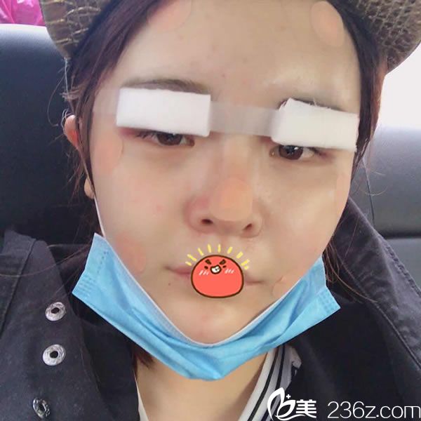 杭州連天美剛做完脂肪填充照片 杭州連天美剛做完脂肪填充照片