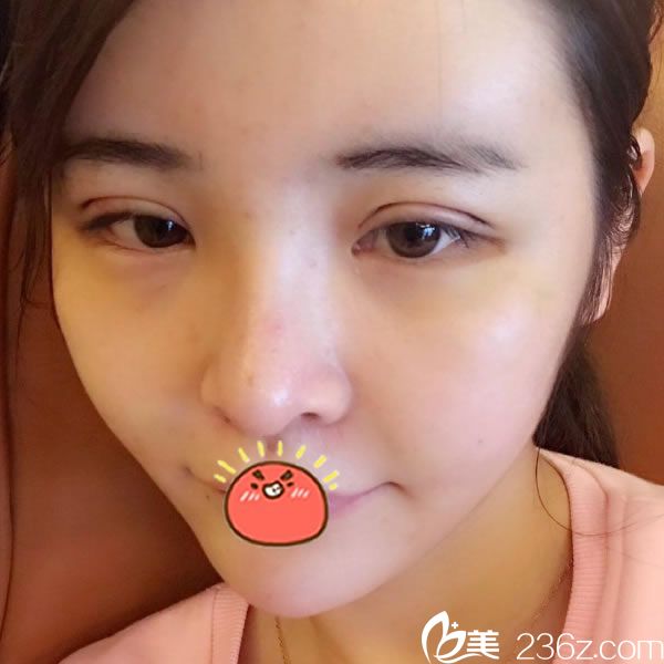 自體脂肪全臉填充和雙眼皮6天效果 自體脂肪全臉填充和雙眼皮6天效果