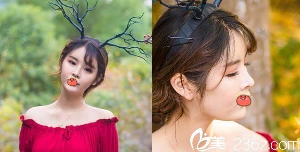 做完雙眼皮和脂肪填充25天照片 做完雙眼皮和脂肪填充25天照片