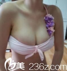 <!--<i data=20240703-sp></i>-->假體隆胸術后半個月 <!--<i data=20240703-sp></i>-->假體隆胸術后半個月