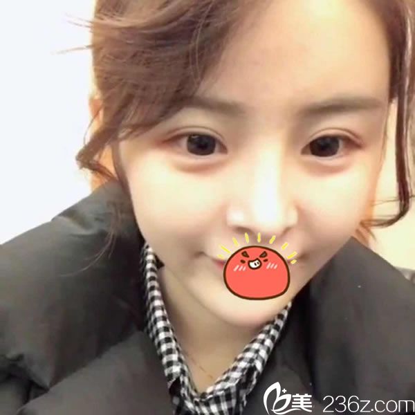 連天美做脂肪填充和雙眼皮3個月后 連天美做脂肪填充和雙眼皮3個月后