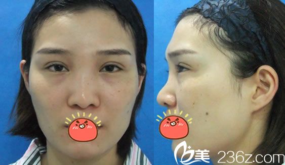 在寧波時光美極做隆鼻手術(shù)前 在寧波時光美極做隆鼻手術(shù)前