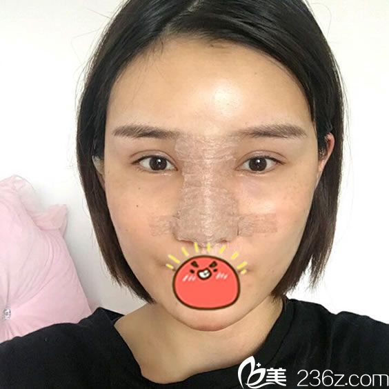 在寧波時光美極剛做完隆鼻和脂肪填充照片 在寧波時光美極剛做完隆鼻和脂肪填充照片