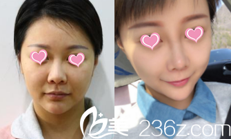 北京華韓假體隆鼻