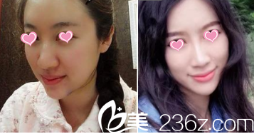 北京華韓面部吸脂