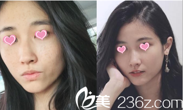 北京華韓去痘印