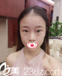 術(shù)前鼻子塌平鼻翼寬大 術(shù)前鼻子塌平鼻翼寬大