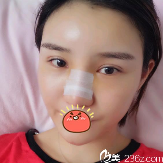 做完膨體耳軟骨鼻綜合和脂肪填充10天后 做完膨體耳軟骨鼻綜合和脂肪填充10天后