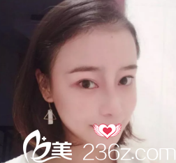 恢復(fù)7天的鼻綜合鼻子高挺 恢復(fù)7天的鼻綜合鼻子高挺