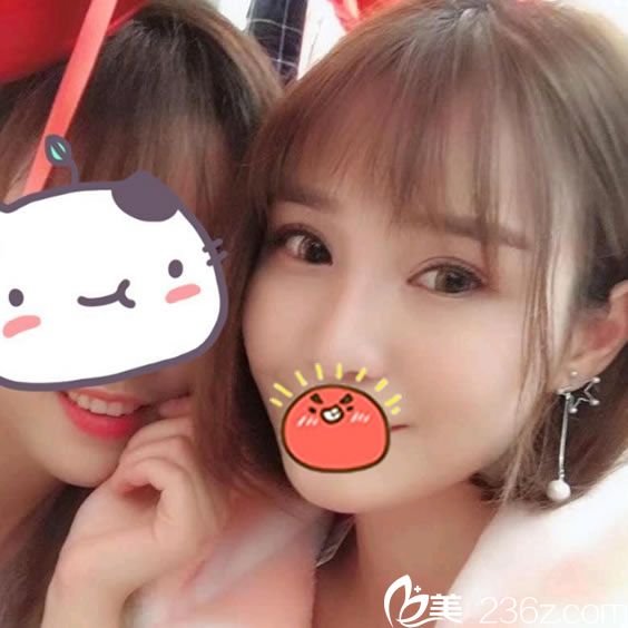 做完自體脂肪填充和隆鼻3個月照片 做完自體脂肪填充和隆鼻3個月照片