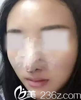 運(yùn)城麗都楊順新院長(zhǎng)給我做鼻綜合隆鼻術(shù)后第2天照片 運(yùn)城麗都楊順新院長(zhǎng)給我做鼻綜合隆鼻術(shù)后第2天照片