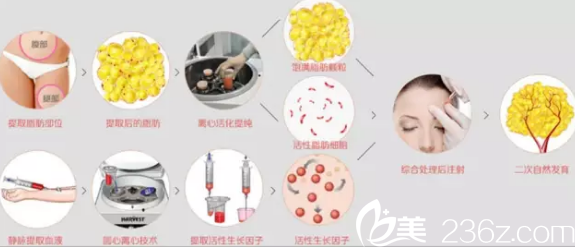 長春東方自體脂肪豐額頭手術(shù) 長春東方自體脂肪豐額頭手術(shù)