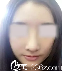 我早運(yùn)城麗都楊順新做鼻整形術(shù)后一周拆線的照片 我早運(yùn)城麗都楊順新做鼻整形術(shù)后一周拆線的照片