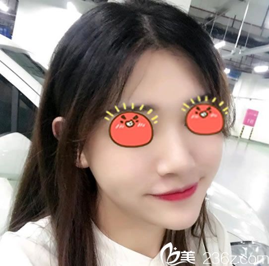 關(guān)注寧波時(shí)光美極康樹勇院長半年后,終于找他做了大腿抽脂和面部自體脂肪填充全臉