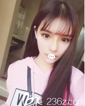 阜陽東方美萊塢線雕隆鼻術(shù)后效果怎么樣