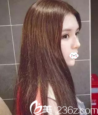 阜陽東方美萊塢線雕隆鼻術(shù)后恢復(fù)效果圖