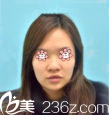 去韓國(guó)KSJ整形外科面診前的我 去韓國(guó)KSJ整形外科面診前的我