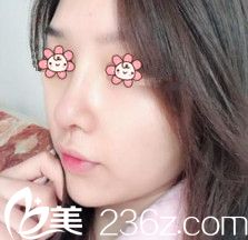 金順珍鼻綜合術(shù)后半個(gè)月 金順珍鼻綜合術(shù)后半個(gè)月