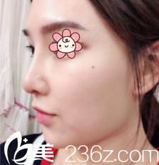 原來他們說韓國(guó)KSJ整形外科金順珍做膨體隆鼻+鼻綜合效果好不是空穴來風(fēng)！