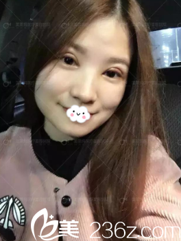 阜陽東方美萊塢雙眼皮效果怎么樣？高士乾真人案例