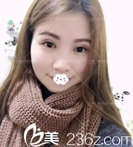 阜陽東方美萊塢雙眼皮術(shù)后15天效果圖