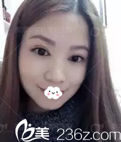 通過阜陽東方美萊塢高士乾切開雙眼皮案例圖了解阜陽做雙眼皮哪家好？