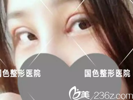 程新德割雙眼皮開眼角術(shù)后第3天恢復(fù)情況