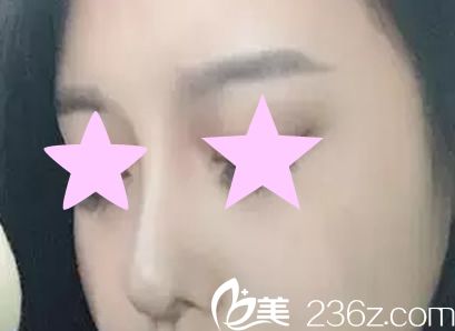 韓國(guó)YNT整形醫(yī)院尹炯老醫(yī)生給我做了硅膠假體隆鼻后 鼻子更立體了