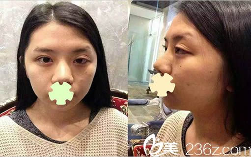 韓國安娜柯琳整形雙眼皮修復(fù)術(shù)前照 韓國安娜柯琳整形雙眼皮修復(fù)術(shù)前照