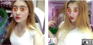 韓國休&美整形外科徐義錫假體隆鼻真人案例術(shù)后第七天