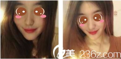 韓國休&美整形外科徐義錫假體隆鼻真人案例術(shù)后一個(gè)月