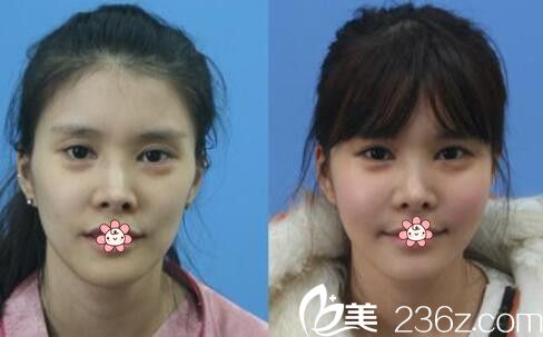 張瓊浩自體脂肪面部填充案例