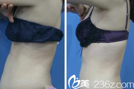 林洪哲院長腰腹部吸脂案例