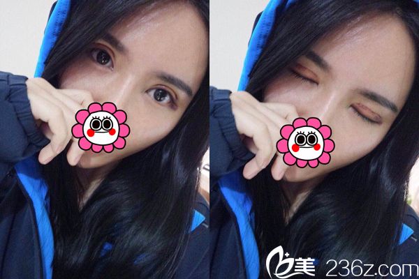 術(shù)后15天效果 術(shù)后15天效果