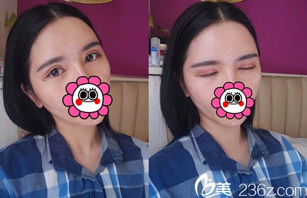 術(shù)后25天效果 術(shù)后25天效果