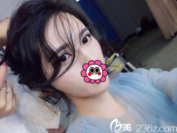 很開心武漢涵美設(shè)計的切開雙眼皮讓我變電眼美女