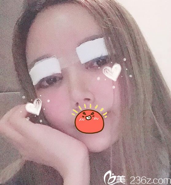 杭州連天美雙眼皮修復(fù)當(dāng)天 杭州連天美雙眼皮修復(fù)當(dāng)天