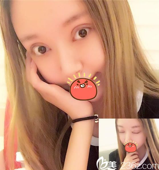 找杭州姜鑫利做雙眼皮修復(fù)9天后 找杭州姜鑫利做雙眼皮修復(fù)9天后