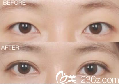 東莞水立方美容醫(yī)院雙眼皮案例圖 東莞水立方美容醫(yī)院雙眼皮案例圖