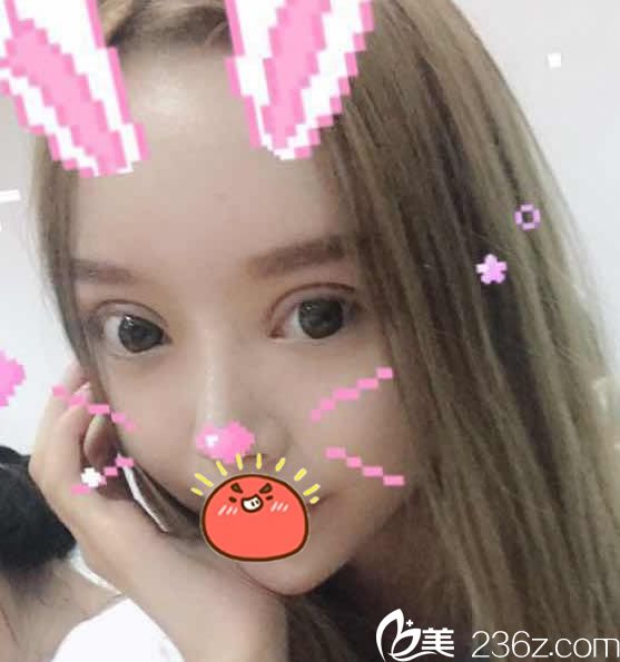 做完雙眼皮修復(fù)和內(nèi)外眼角20天效果 做完雙眼皮修復(fù)和內(nèi)外眼角20天效果