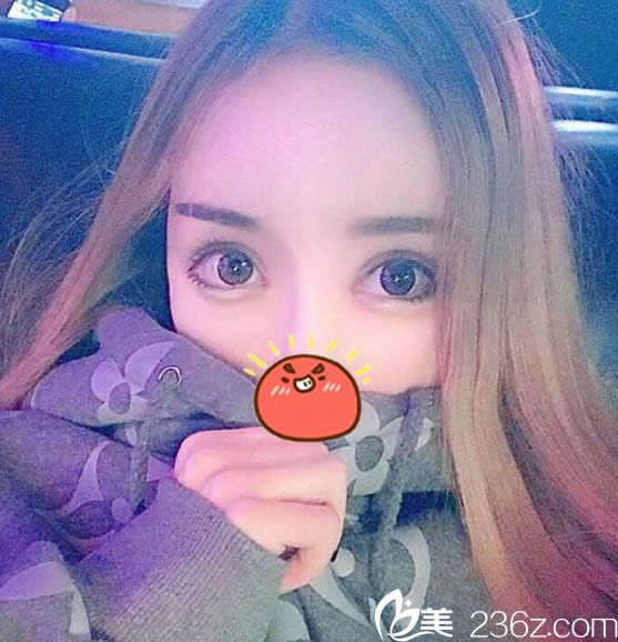 杭州姜鑫利雙眼皮修復(fù)案例80天效果 杭州姜鑫利雙眼皮修復(fù)案例80天效果