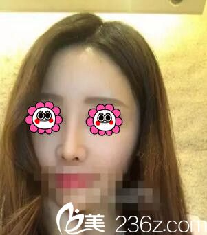 鼻綜合術(shù)后半個月<span style= 鼻綜合術(shù)后半個月<span style=