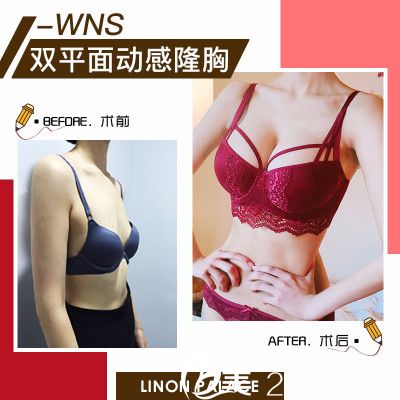 珠海新顏曾超假體隆胸案例對(duì)比圖 珠海新顏曾超假體隆胸案例對(duì)比圖