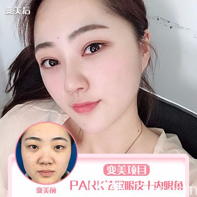 珠海新顏曾超醫(yī)生雙眼皮開眼角案例 珠海新顏曾超醫(yī)生雙眼皮開眼角案例