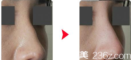 韓國(guó)Re Yeon K整形外科醫(yī)院隆鼻案例 韓國(guó)Re Yeon K整形外科醫(yī)院隆鼻案例