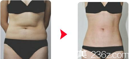 韓國(guó)Re Yeon K整形外科醫(yī)院金賢秀激光腹部吸脂案例 韓國(guó)Re Yeon K整形外科醫(yī)院金賢秀激光腹部吸脂案例