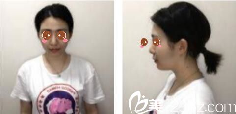 韓國莫德羅皮膚科徐求一埋線提升真人案例術(shù)前照 韓國莫德羅皮膚科徐求一埋線提升真人案例術(shù)前照