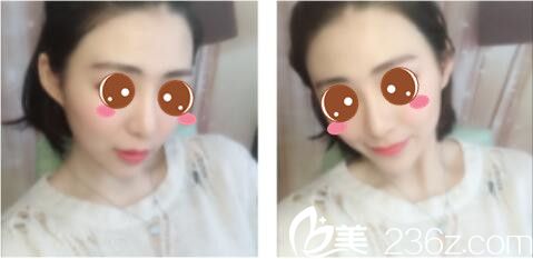 韓國莫德羅皮膚科徐求一埋線提升真人案例術(shù)后第七天 韓國莫德羅皮膚科徐求一埋線提升真人案例術(shù)后第七天