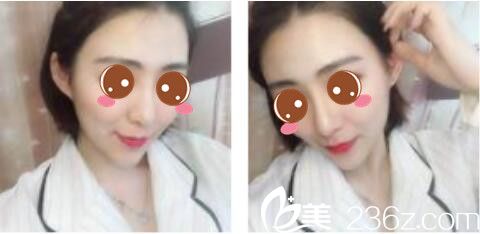 韓國莫德羅皮膚科徐求一埋線提升真人案例術(shù)后十五天 韓國莫德羅皮膚科徐求一埋線提升真人案例術(shù)后十五天