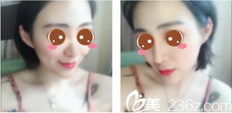 韓國莫德羅皮膚科徐求一埋線提升真人案例術(shù)后一個月 韓國莫德羅皮膚科徐求一埋線提升真人案例術(shù)后一個月